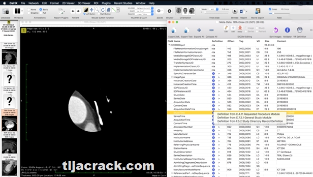 OsiriX MD Crack